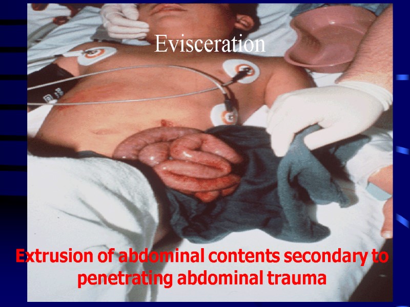 Evisceration Extrusion of abdominal contents secondary to penetrating abdominal trauma